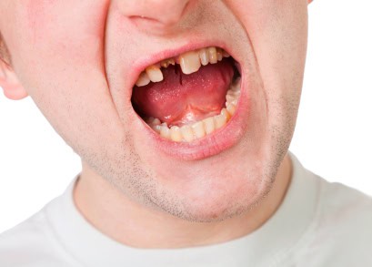 Broke Tooth Settlements Accident Florida