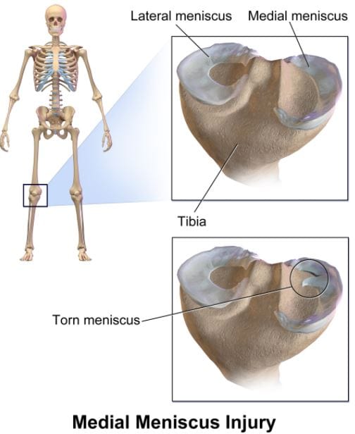 torn mensicus - medial meniscus injury