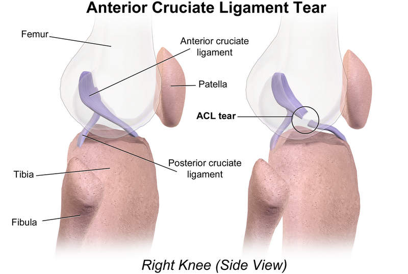Anterior Cruciate Ligament (ACL) Tear