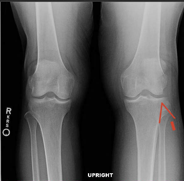 image of tibial plateau