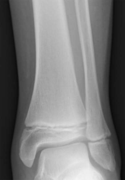 Tibia and Fibula Growth Plates