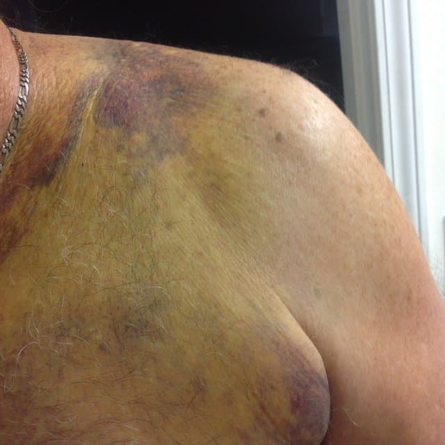 bruising to motorcycle rider's collarbone and chest