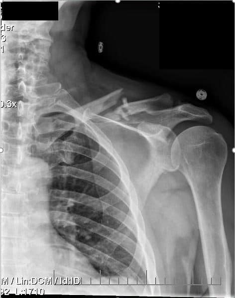 collarbone clavicle (communited) fracture x-ray