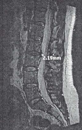 2.19 mm herniated disc lower back L2-L3