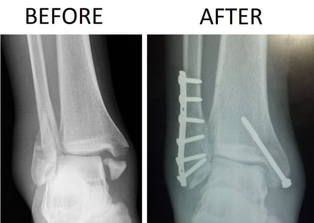 640px-Trimalleolar_Ankle_Fracture_Xray_shown_before_surgery_and_after_surgery