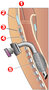 Tracheotomy