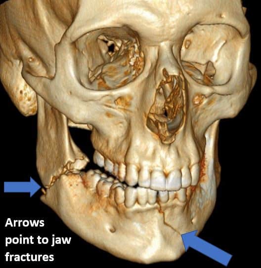 Broken jaw (in two places)
