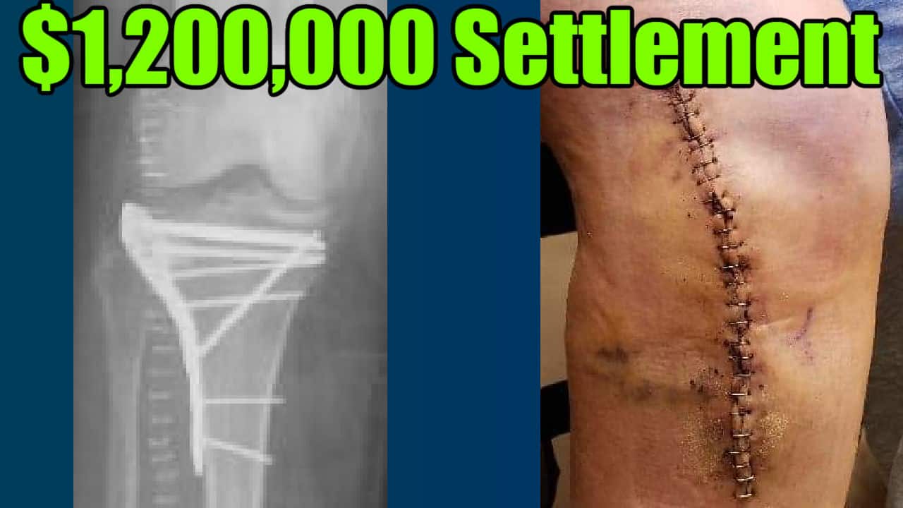 Plate and screws (left image), and staples (right image) after surgery to tibial plateau fracture