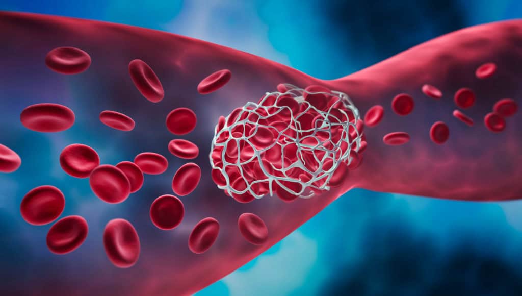 blood clot, Deep vein thrombosis (DVT)