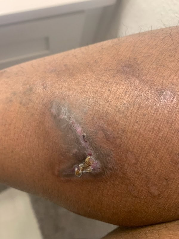 Close-up of Mike’s leg showing a healing dog bite wound with visible scarring and discoloration.