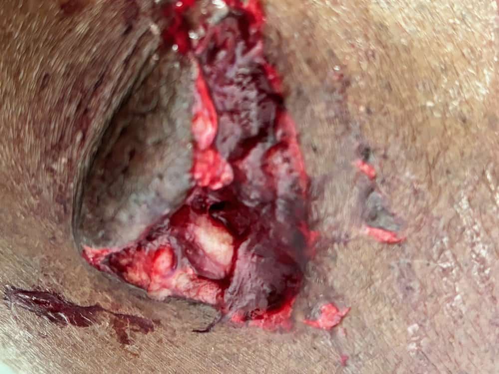 Graphic close-up of Mike’s deep, open dog bite wound, exposing raw tissue and severe trauma before treatment.