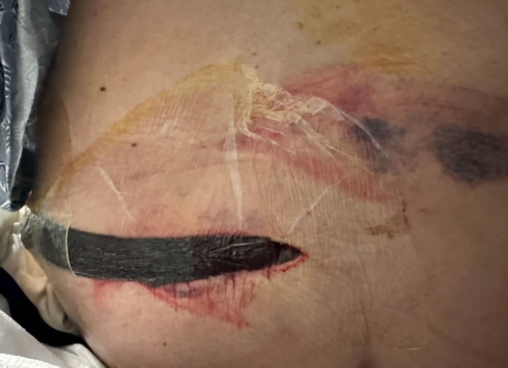 Lower back after surgery with clear bandage covering the wound. Bruising and redness are visible around the area.