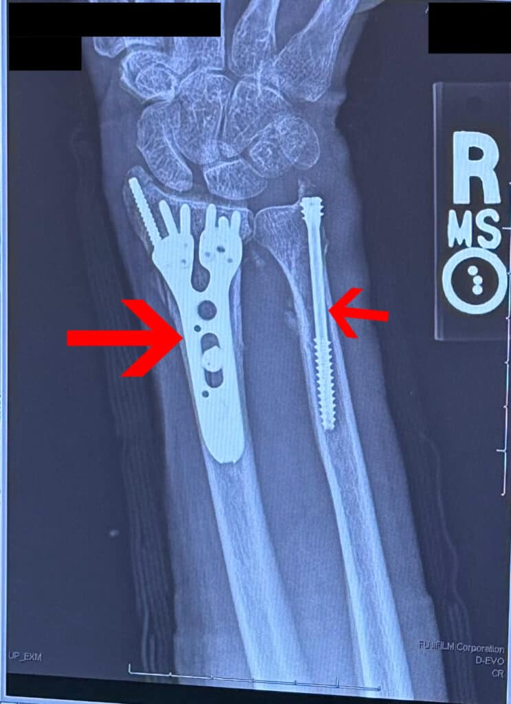 X-ray of Maria's wrist surgery showing internal plates and screws used to repair fractures in a $479,000 State Farm car accident settlement.
