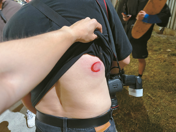 Rubber bullet mark on reporter’s back after LAPD response during Koreatown protest