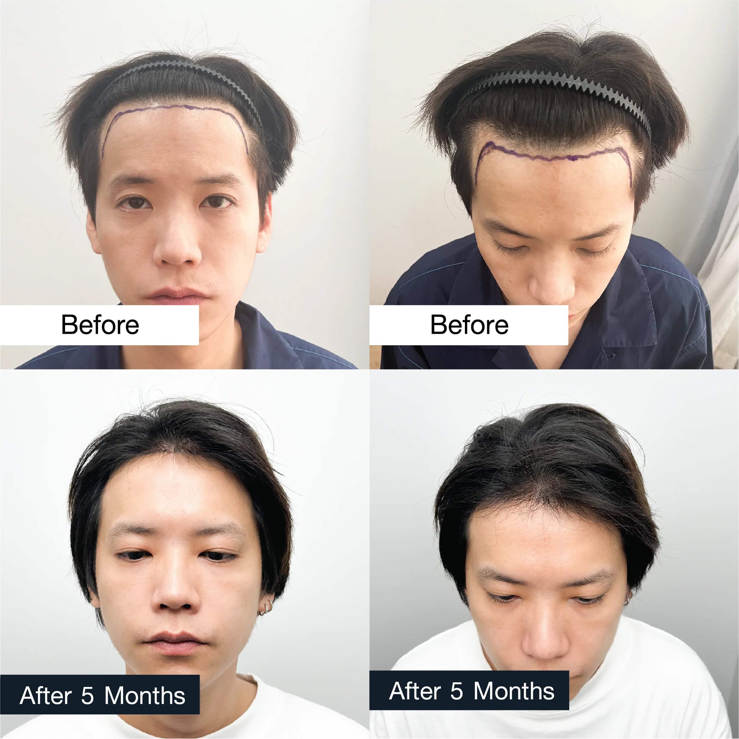 Hair transplant before and after 5 months in young man shown from front and top angles.