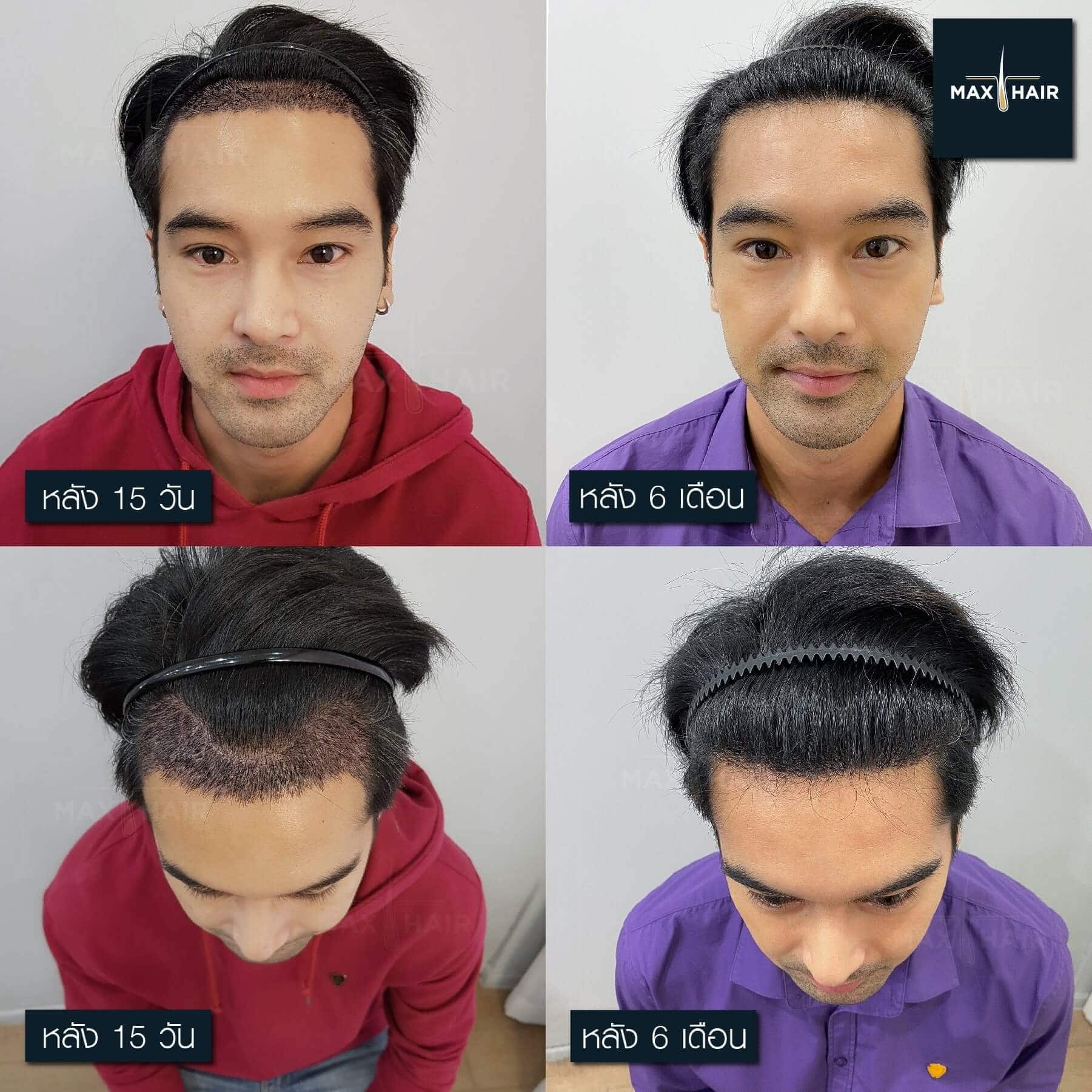 เปรียบเทียบก่อนและหลังผ่านไป 15 วันและ 6 เดือนของการปลูกผม ออฟ ชนะพล