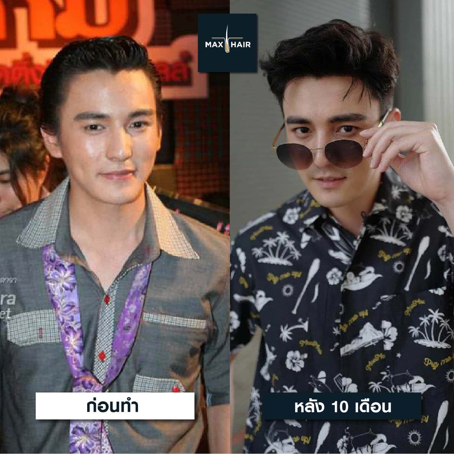 เปรียบเทียบก่อนและหลังผ่านไป 10 เดือน การปลูกผมเคสคุณธันวา สุริยจักร