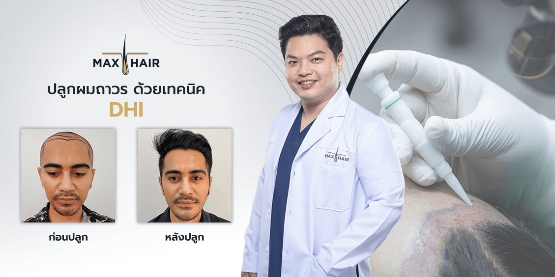 เปรียบเทียบก่อนและหลังการปลูกผมเทคนิคด้วย DHI