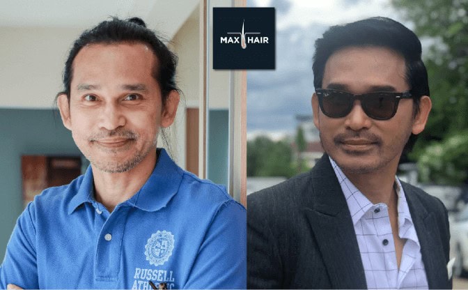 รีวิวปลูกผมจากคุณปราปต์-ปราปต์ปฎล นักแสดง นายแบบ และศิลปินชาวไทย