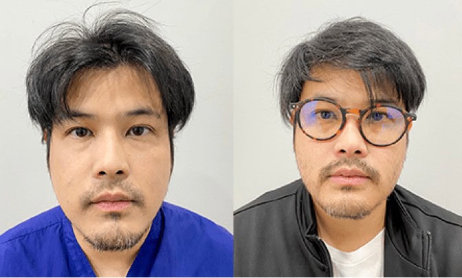 รีวิวปลูกผมจากคุณเติ้ล-ตะวัน จารุจินดา ผู้จัดละครและผู้กำกับชื่อดัง