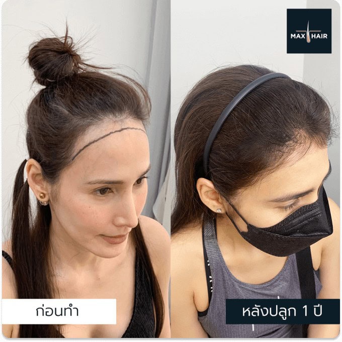 รวมเคสรีวิวปลูกผมสำหรับผู้หญิงที่ Max Hair Clinic