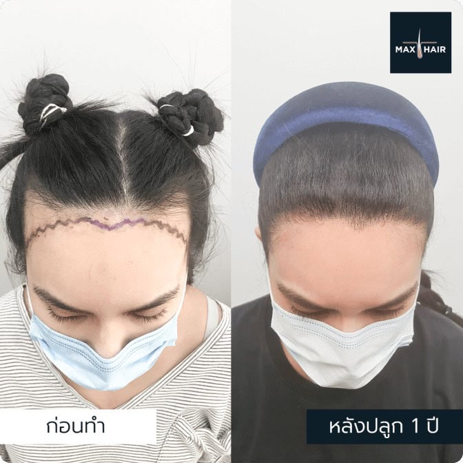 รีวิวปลูกผมผู้หญิง เทคนิค MCG 2,000 กราฟ