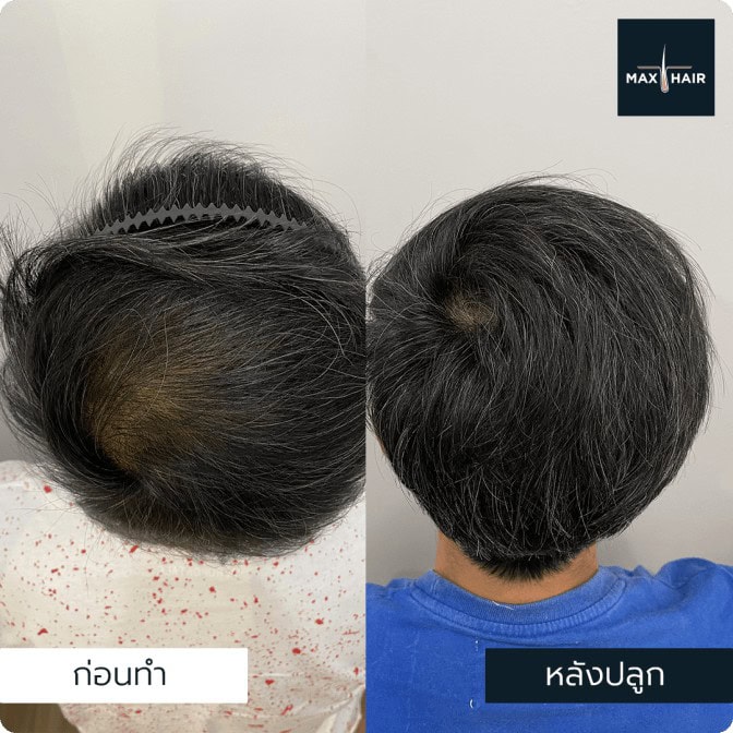 รีวิวรักษาผมบาง ผลลัพธ์ชัดเจน - Max Hair (1)