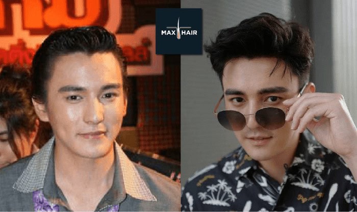 รีวิวปลูกผมจากคุณธันวา สุริยจักร นักแสดงช่อง 7