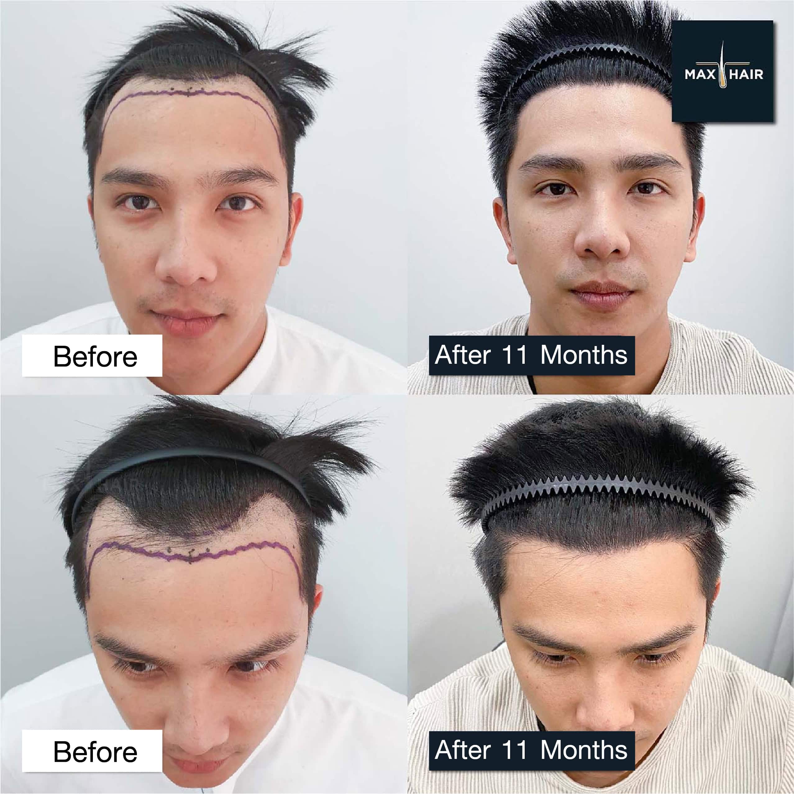 inger On from The Star 9 permanent hair transplant case review and results
