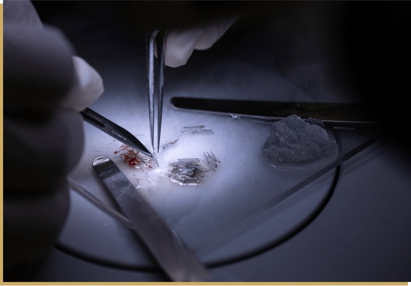 Close up of doctors extracting follicles during an FUE hair transplant