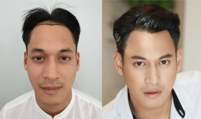 ผลลัพธ์การปลูกผมถาวรของพล-พูลภัทร อัตถปัญญาพล