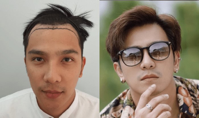 รีวิวผลลัพธ์การปลูกผมถาวรจากคุณอ้น เดอะสตาร์ 9