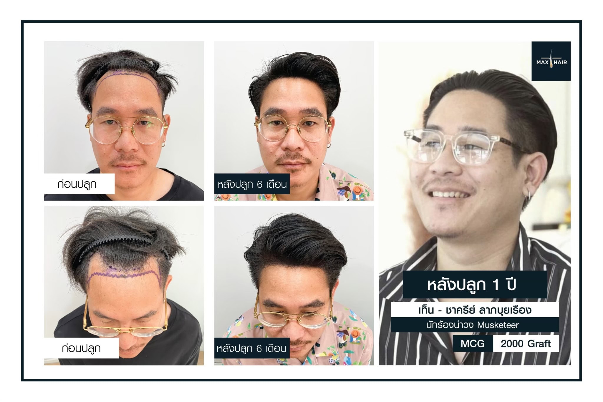รีวิวการปลูกผมจากคุณเท็น ชาครีย์ ลาภบุญเรือง