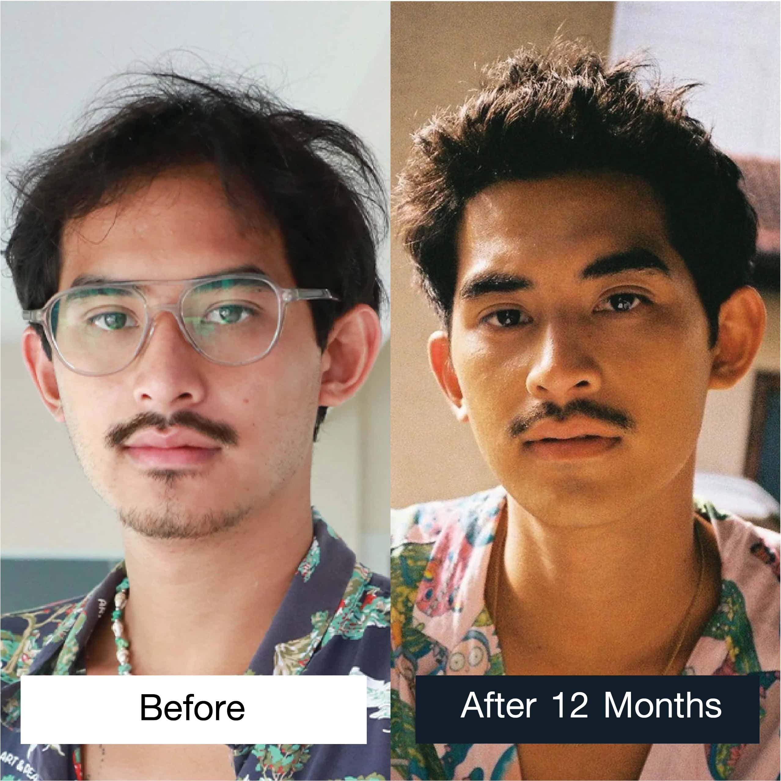 Actor and model Phum Rangseethananon permanent hair transplant case review results