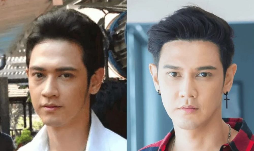 ผลลัพธ์หลังการปลูกผมถาวรของคุณดณฐ์-กณิณ ปัทมนันถ์