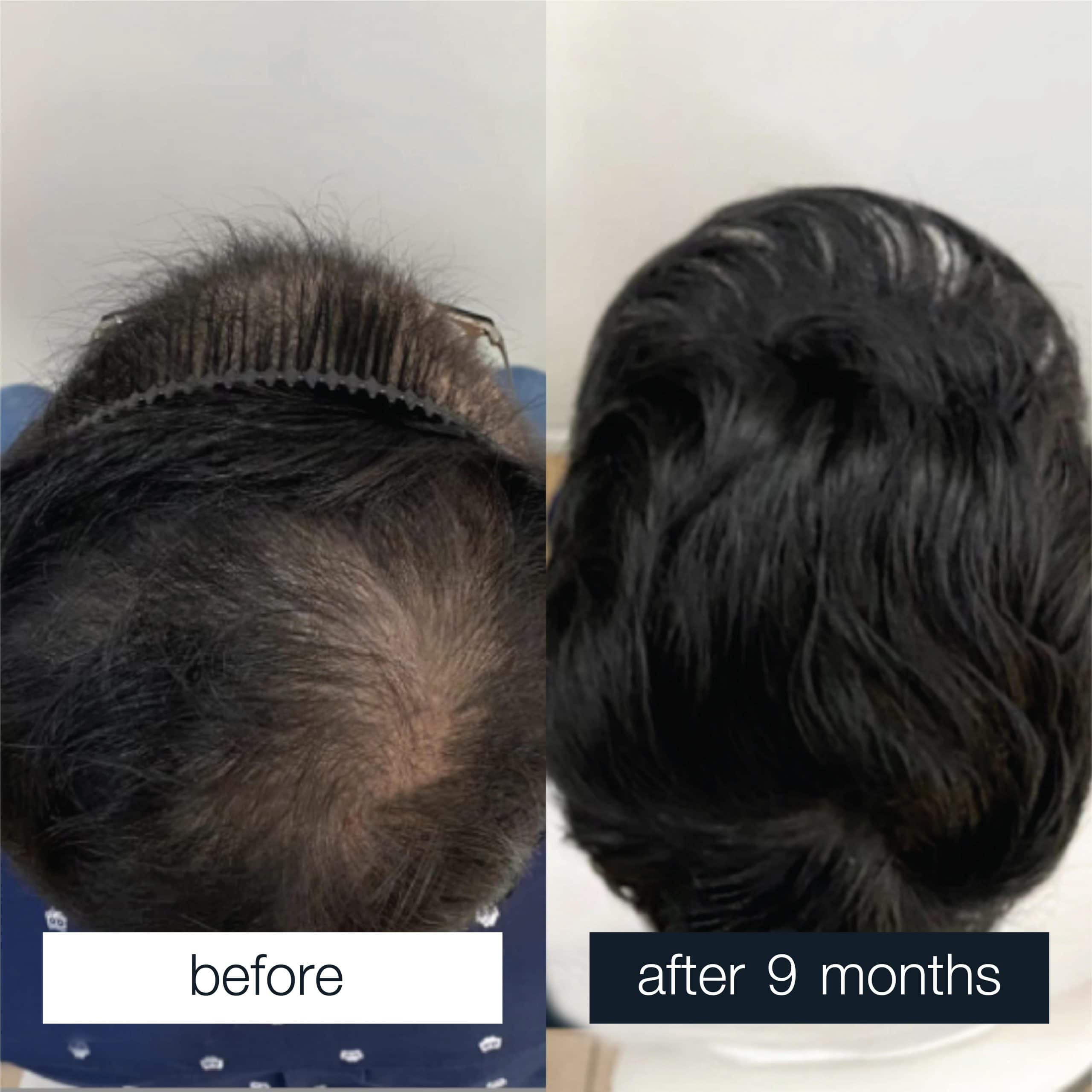 Side by side comparison of a man's head before and 9 months after PRP treatment