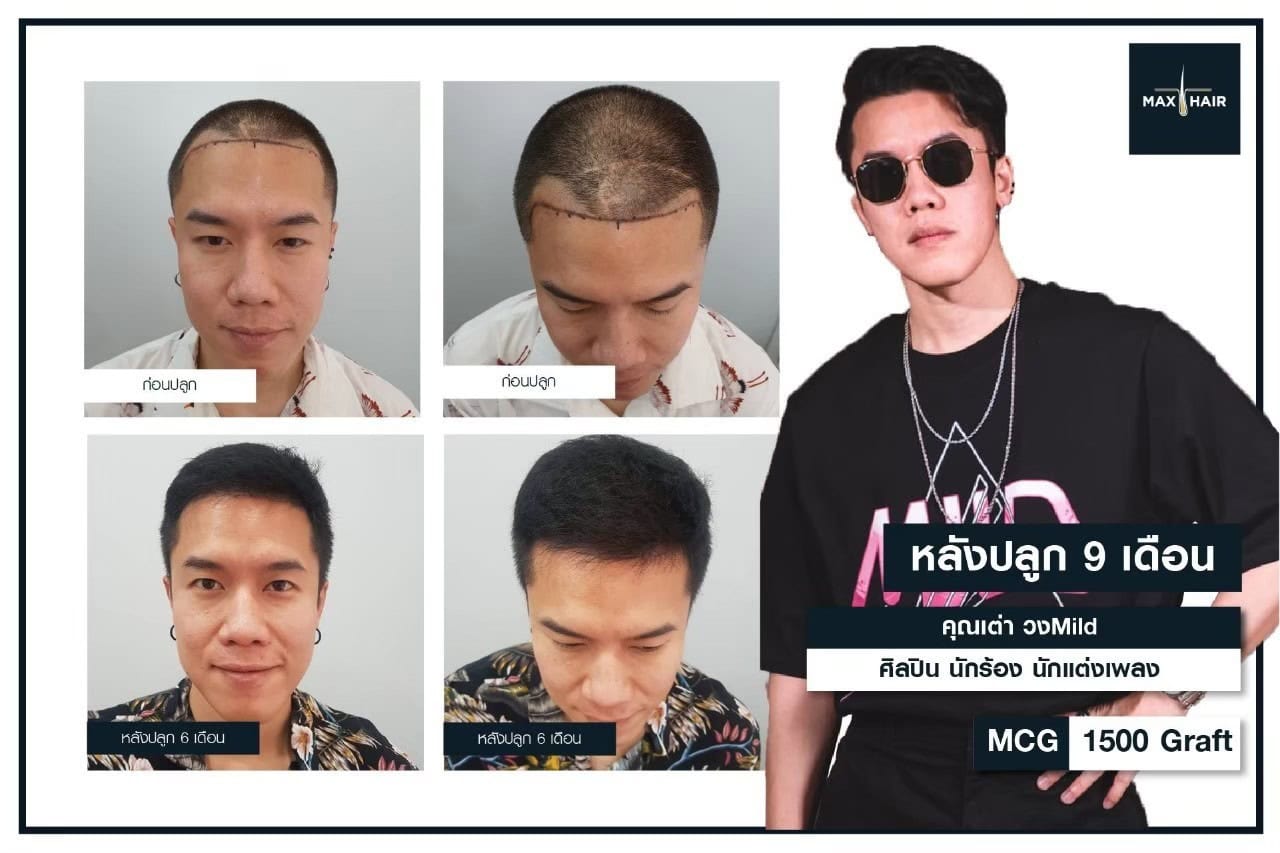 รีวิวปลูกผม คุณเต่า เจน มโนภินิเวศ (เต่า วง MILD) (1)