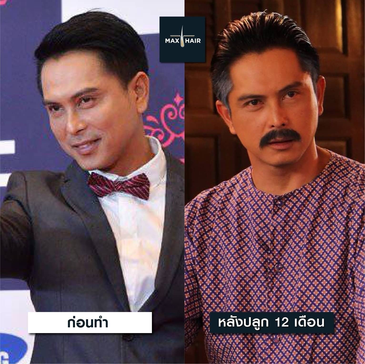 เปรียบเทียบก่อนและหลังผ่านไป 12 เดือนของการปลูกผมเคสคุณกระดุม ธนายง