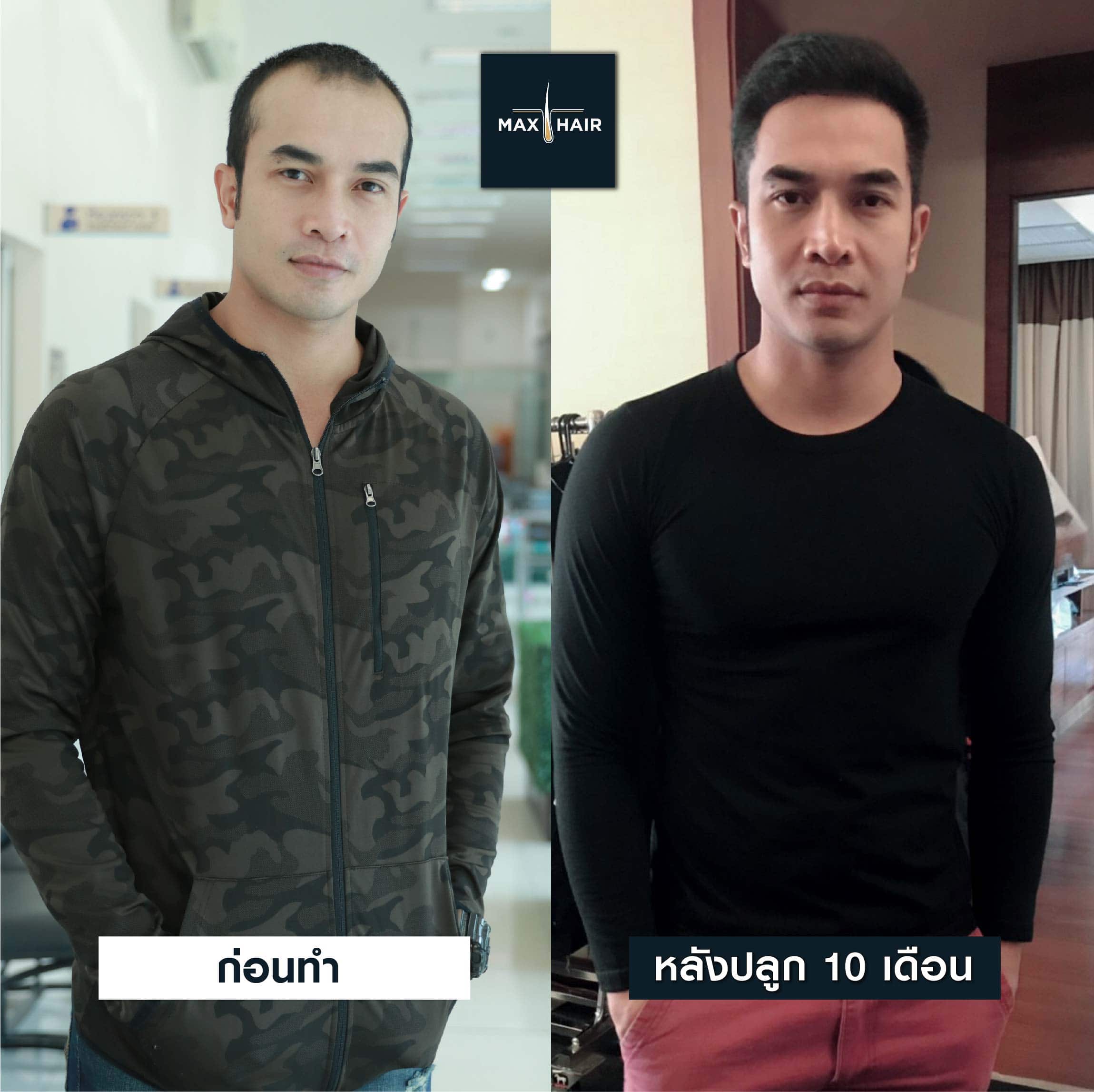 ผลลัพธ์ปลูกผมหลังผ่านไป 10 เดือนของคุณรัล นวรัชล์ (นักแสดงและสตั๊นแมน)