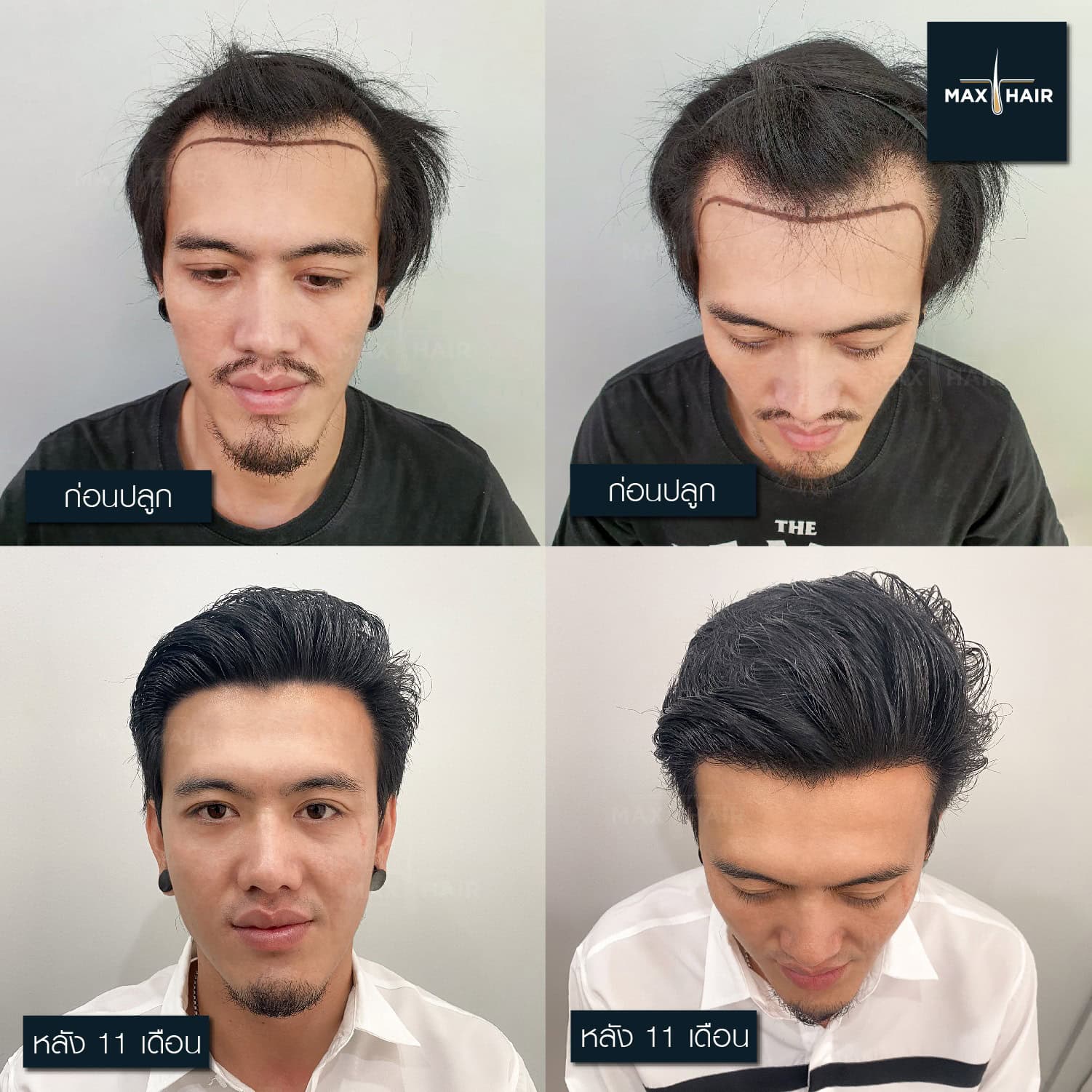 รีวิวปลูกผม คุณทาร์ท อรรถพล ศรีสวัสดิ์