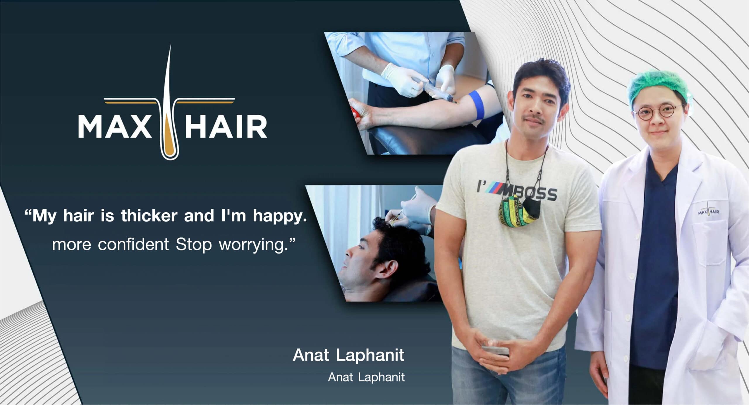 Hair transplant results review Anat Laphanit, actor