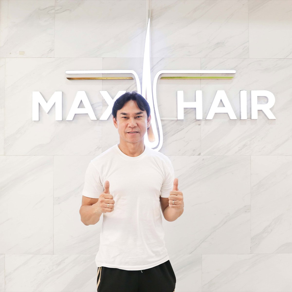คุณตี๋ ดอกสะเดา เข้ารับบริการปลูกผมถาวรที่ Max Hair Clinic