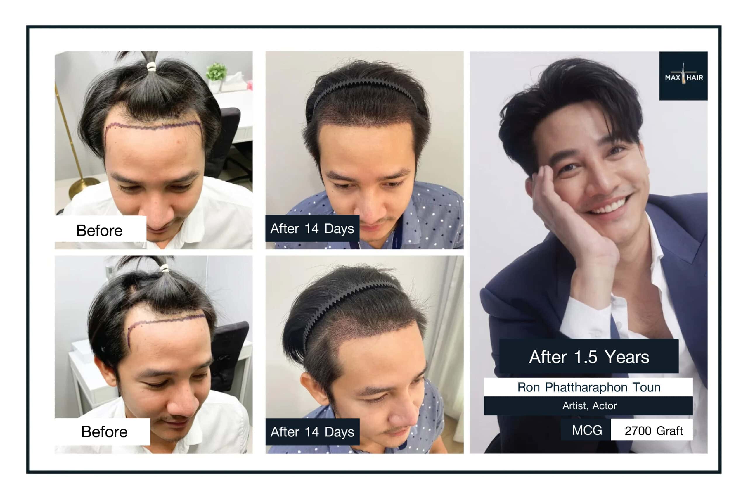 Review for Max Hair Thailand from Ron Phattharaphon To-un