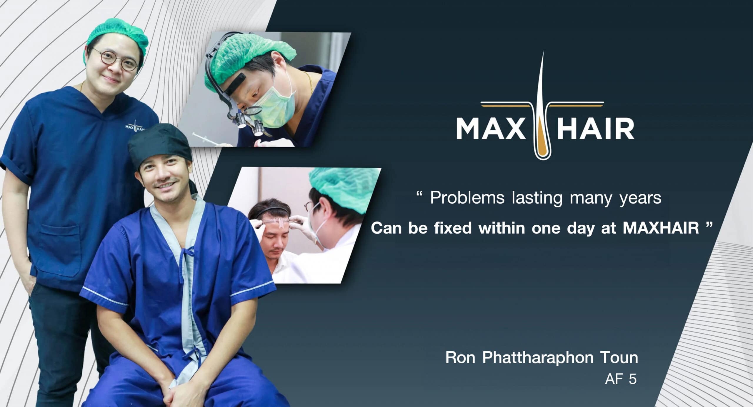 Hair transplant results review Ron Phatthaphon To-un, artist/actor