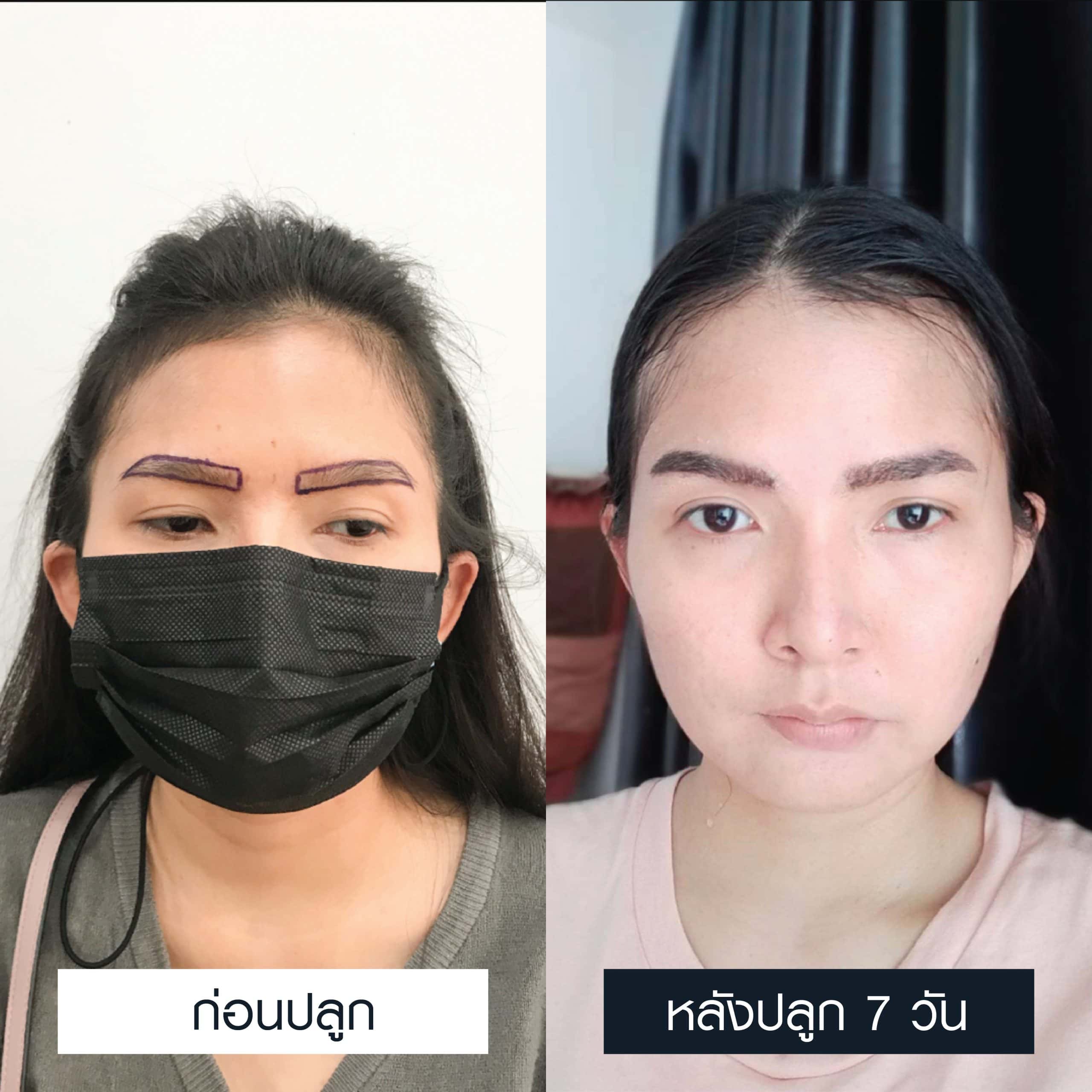 เปรียบเทียบก่อนและหลังผ่านไป 7 วันของการปลูกคิ้วผู้หญิง 700 กราฟต์