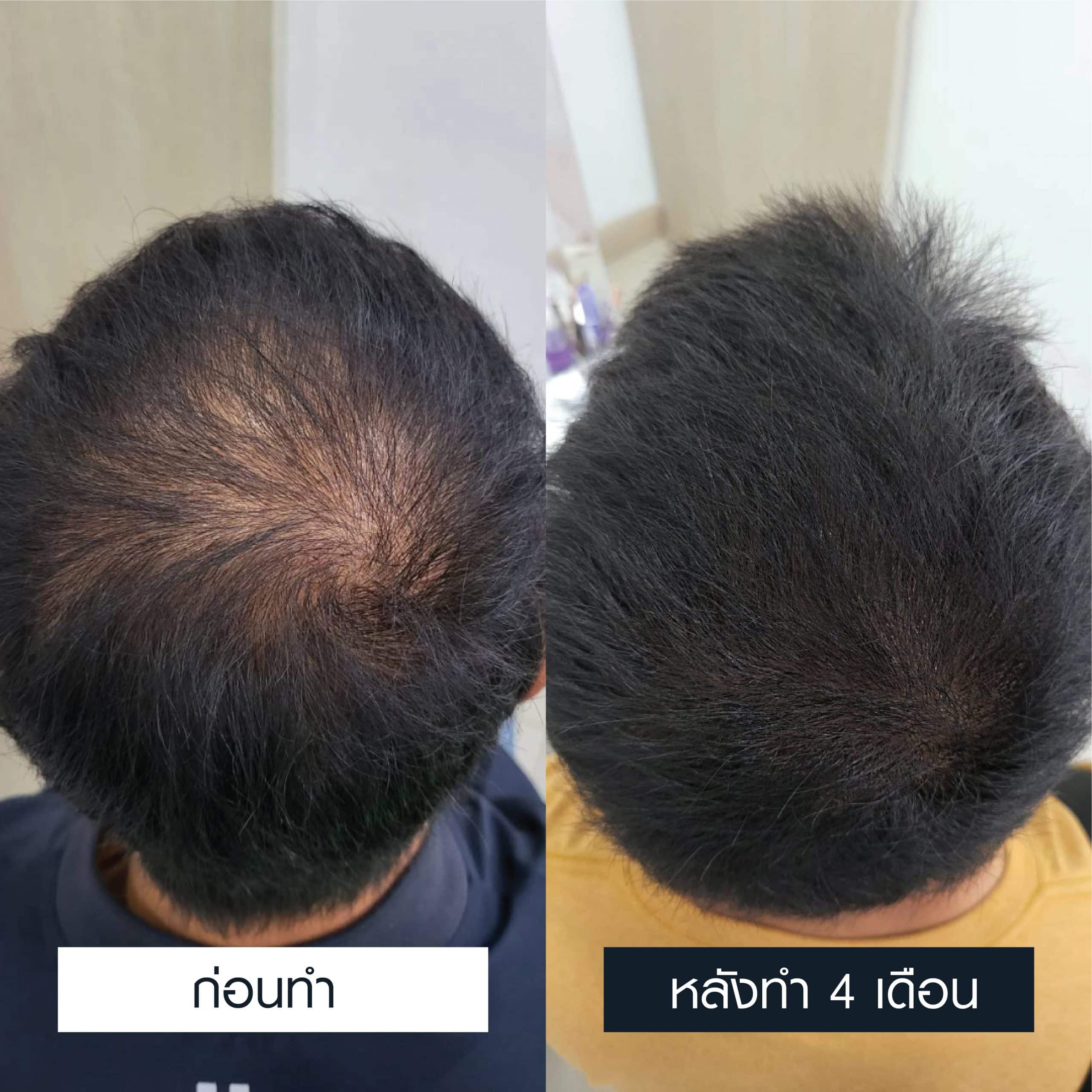 เปรียบเทียบการเพิ่มเส้นผมด้วยเกร็ดเลือดเข้มข้นหลังผ่านไป 4 เดือน