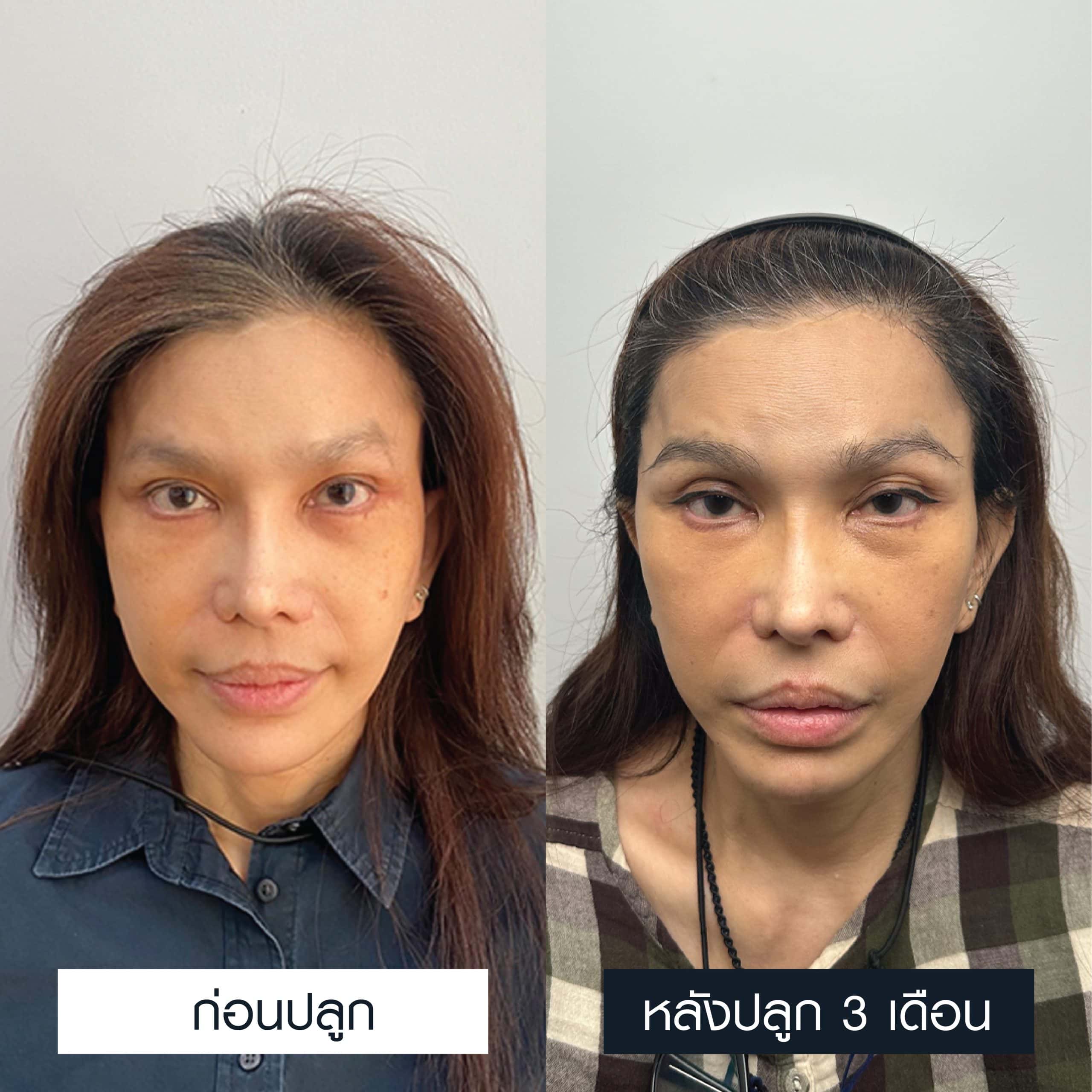 ผู้หญิงรีวิวการปลูกคิ้ว 600 กราฟ ก่อนและหลังทำ 3 เดือน