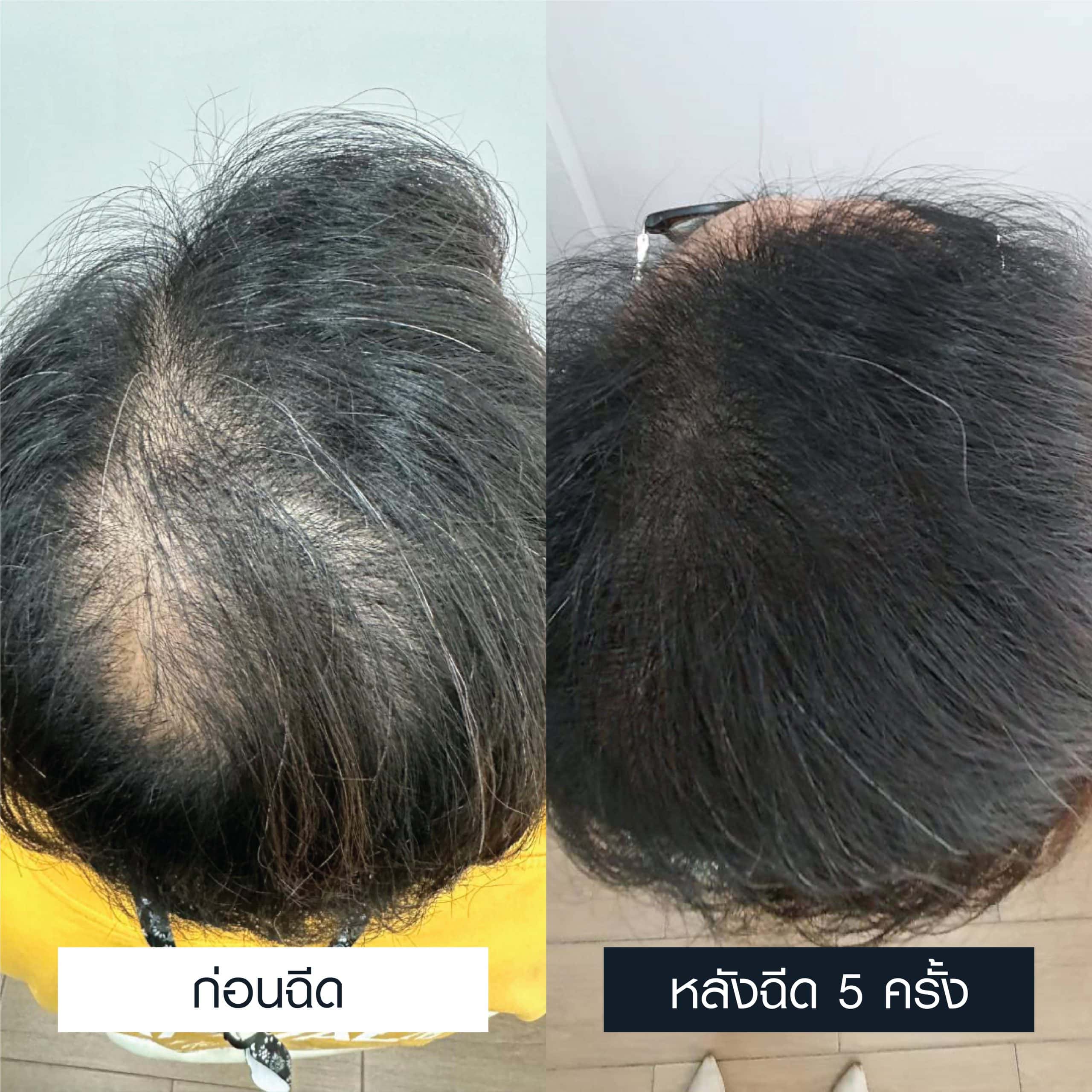 รีวิวผลลัพธ์การรักษาผมบางก่อนและหลังฉีด EXOSOME-2 จำนวน 5 ครั้ง