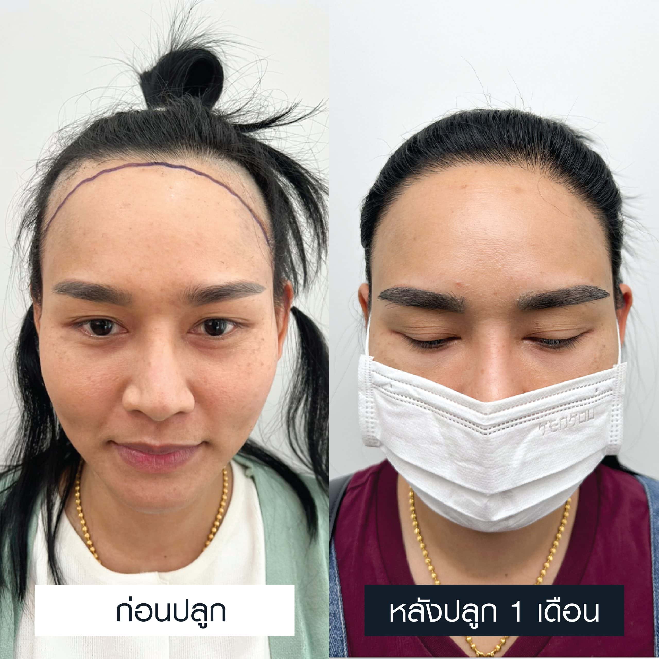 รีวิวก่อนและหลังการปลูกคิ้ว 500 กราฟนาน 1 เดือน
