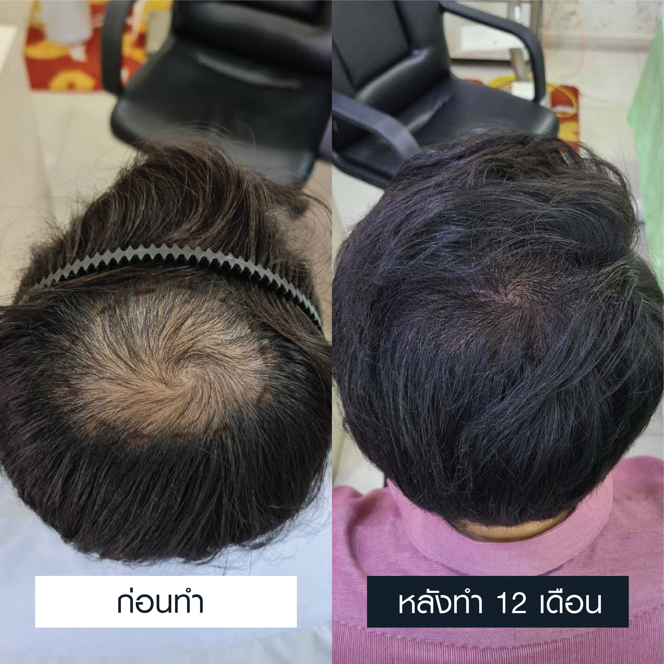 รีวิวผลลัพธ์การรักษาปัญหาผมบาง
